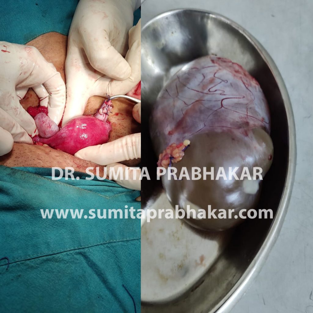 ovarian cystectomy