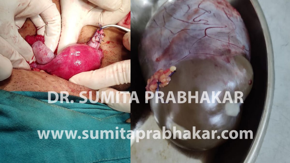 ovarian cystectomy