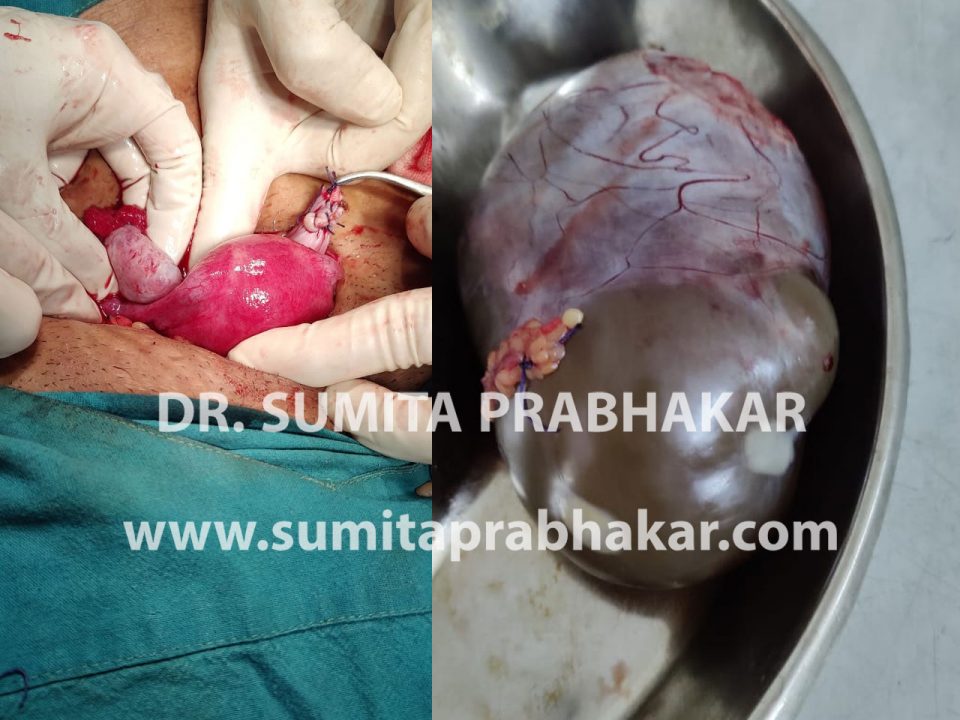 ovarian cystectomy