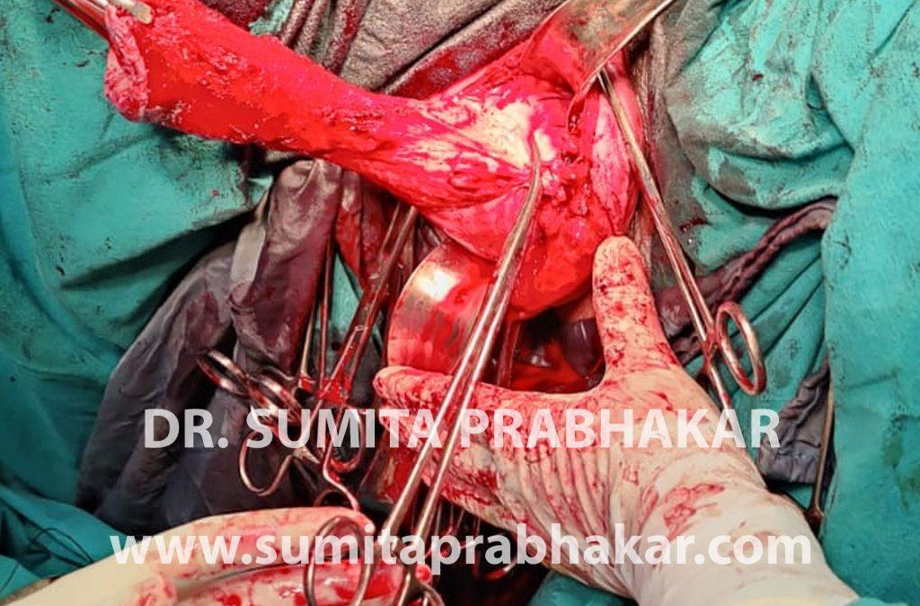 Uterine prolapse surgery by Dr Sumita Prabhakar