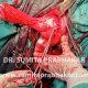 Uterine prolapse surgery by Dr Sumita Prabhakar