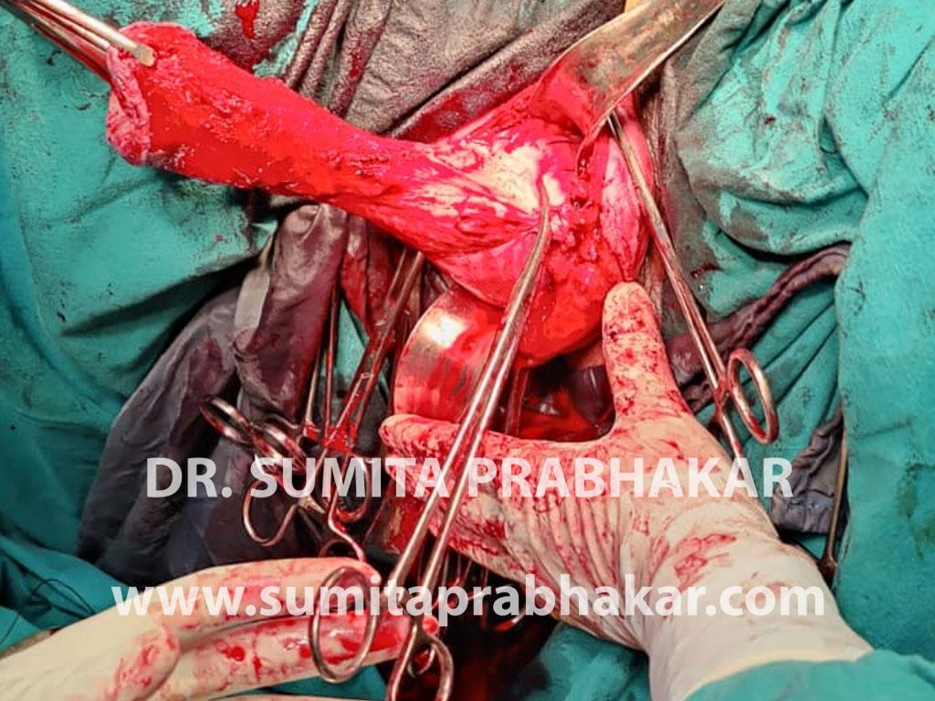 Uterine prolapse surgery by Dr Sumita Prabhakar