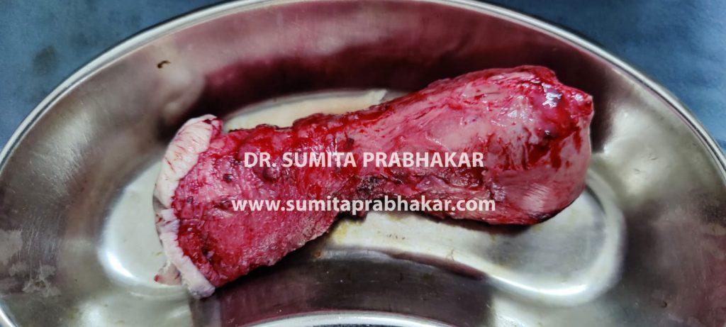 Uterine prolapse surgery by Dr Sumita Prabhakar