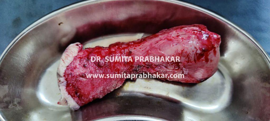 Uterine prolapse surgery by Dr Sumita Prabhakar